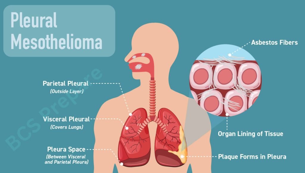 Pleural Mesothelioma